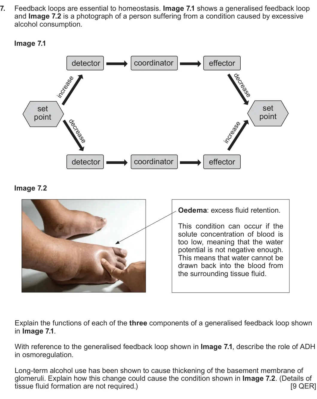 Summer 2024 Unit 3, question 7: Feedback loops are essential to homeostasis. Image 7.1 shows a generalised feedback loop and Image 7.2 is a photograph of a person suffering from a condition ca