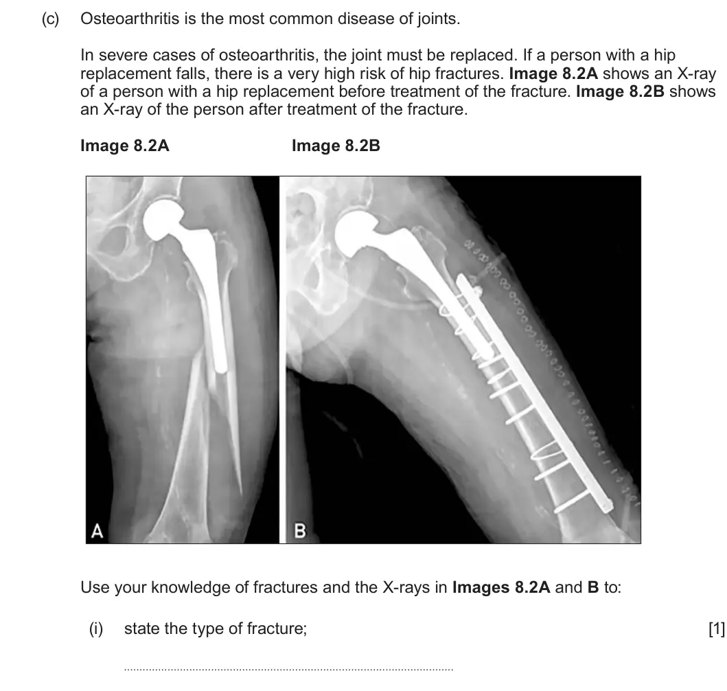 Summer 2025 Unit 4, question 8(c)(i): state the type of fracture; [1]