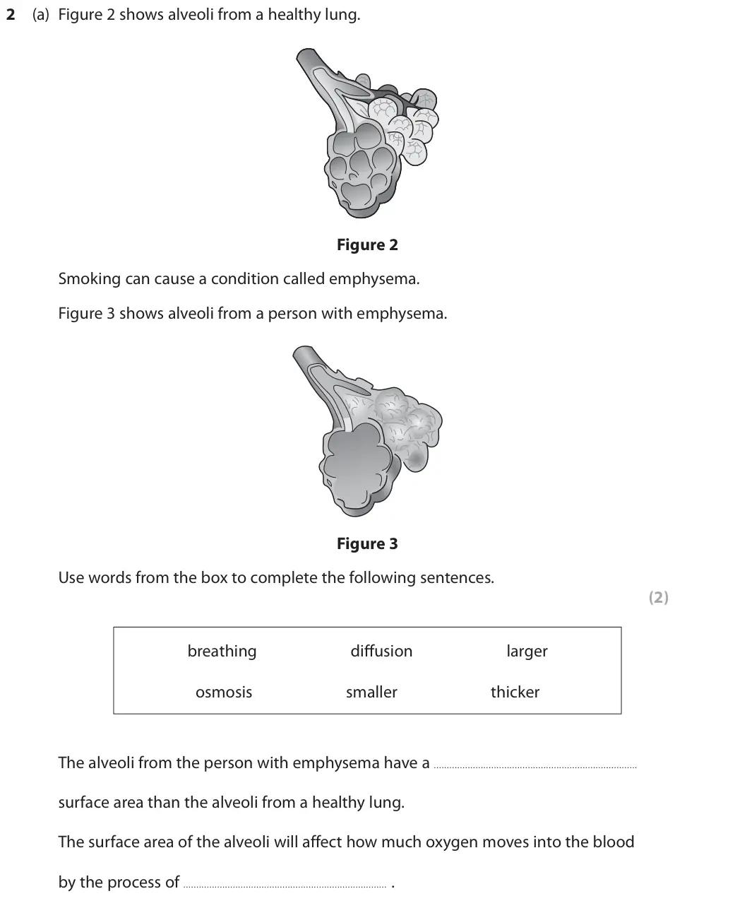 June 2018 Paper 2 Foundation, question 2(a): Figure 2 shows alveoli from a healthy lung. Figure 2 Smoking can cause a condition called emphysema. Figure 3 shows alveoli from a person with emphysema. Figure