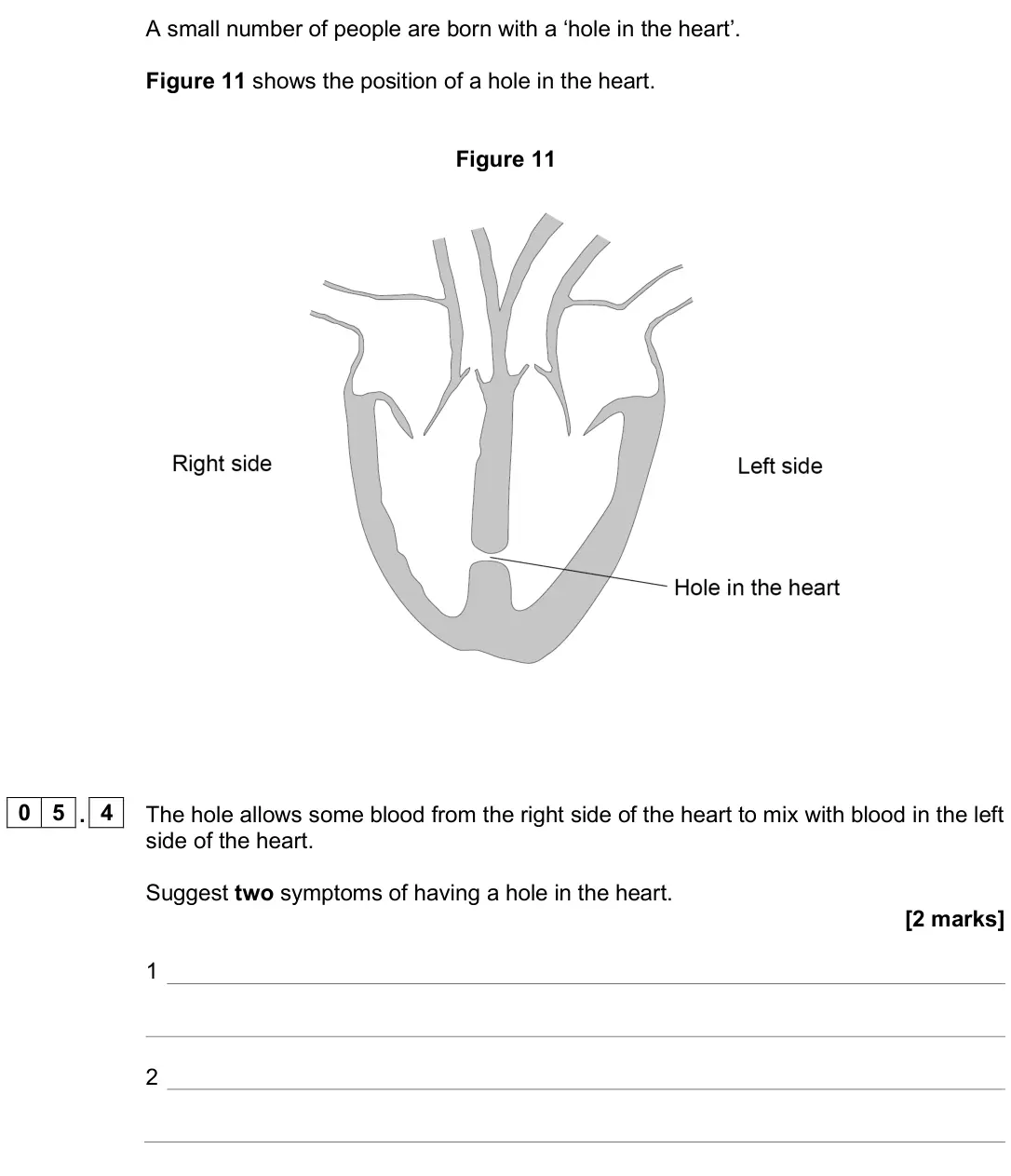 June 2025 Biology Paper 1 Foundation, question 05.4: The hole allows some blood from the right side of the heart to mix with blood in the left side of the heart. Suggest two symptoms of having a hole in the heart.