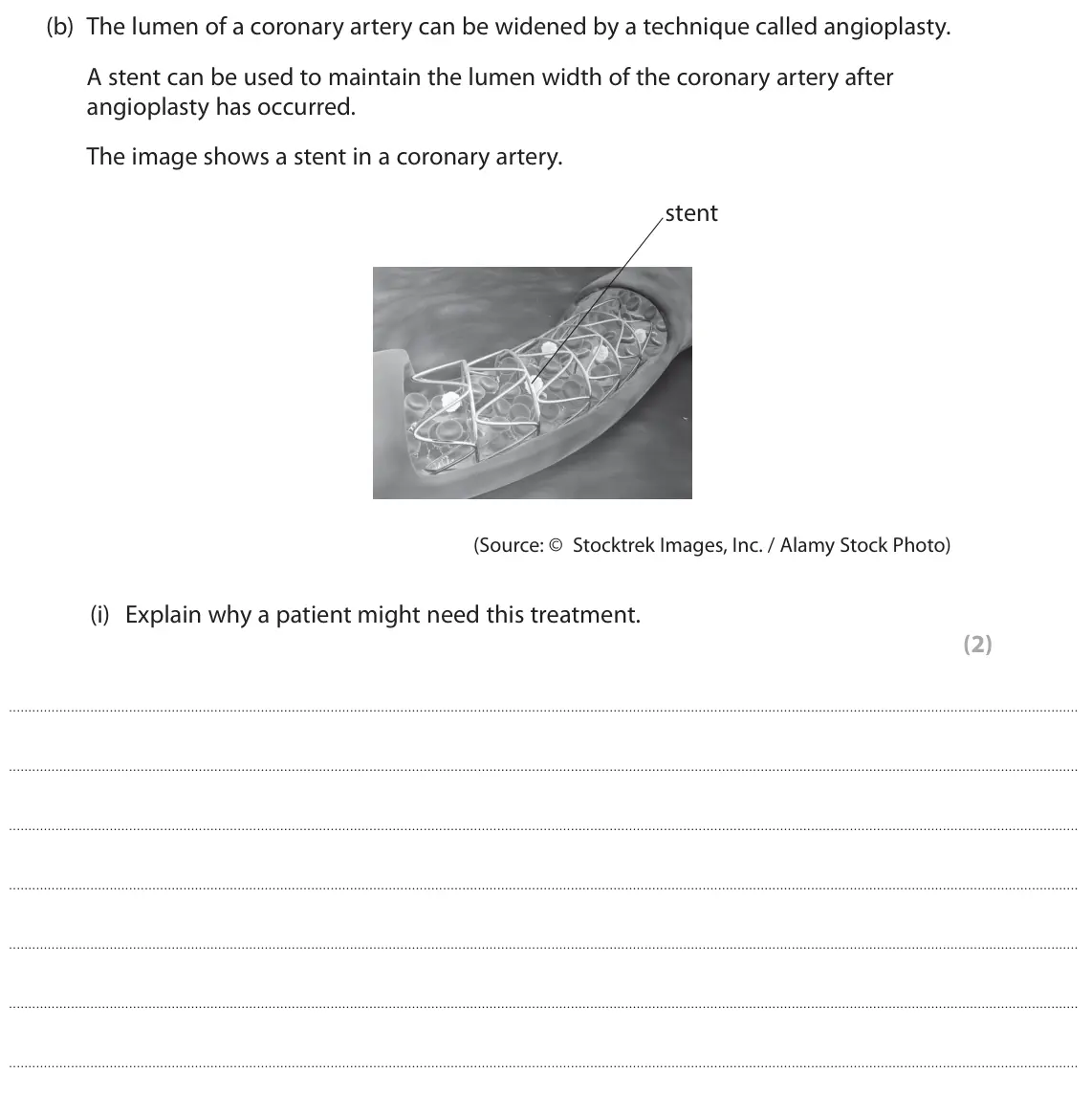 June 2025 AS Paper 1, question 5(b)(i): Explain why a patient might need this treatment. (2)