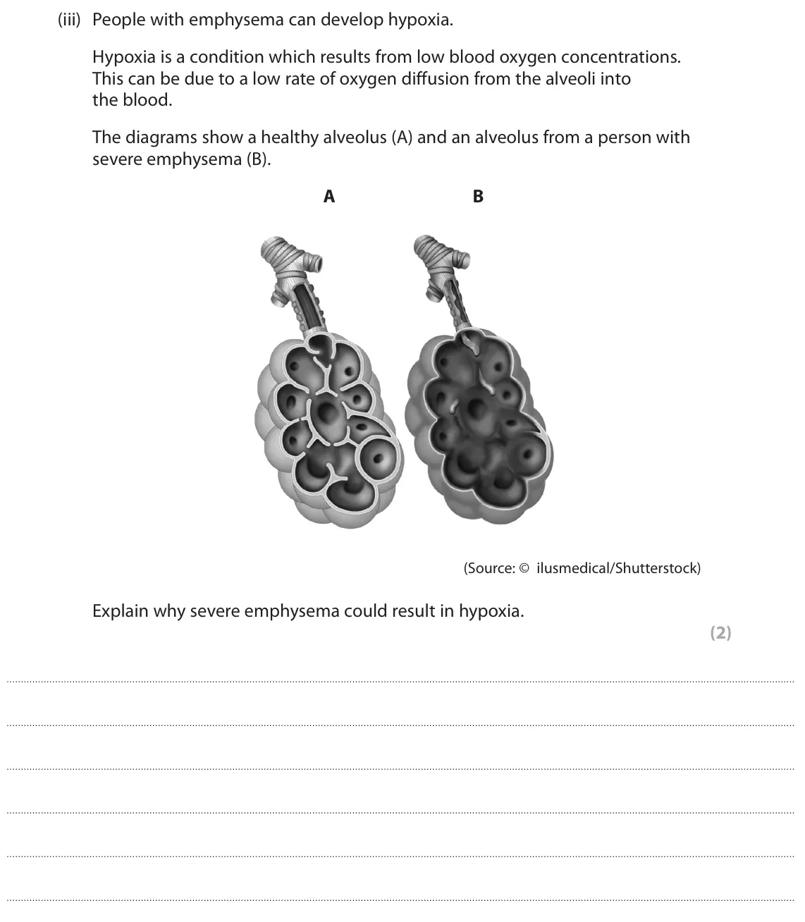 June 2025 AS Paper 1, question 8(a)(iii): People with emphysema can develop hypoxia. Hypoxia is a condition which results from low blood oxygen concentrations. This can be due to a low rate of oxygen di