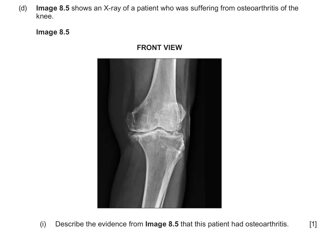 June 2025 Component 3, question 8(d)(i): Describe the evidence from Image 8.5 that this patient had osteoarthritis. [1]