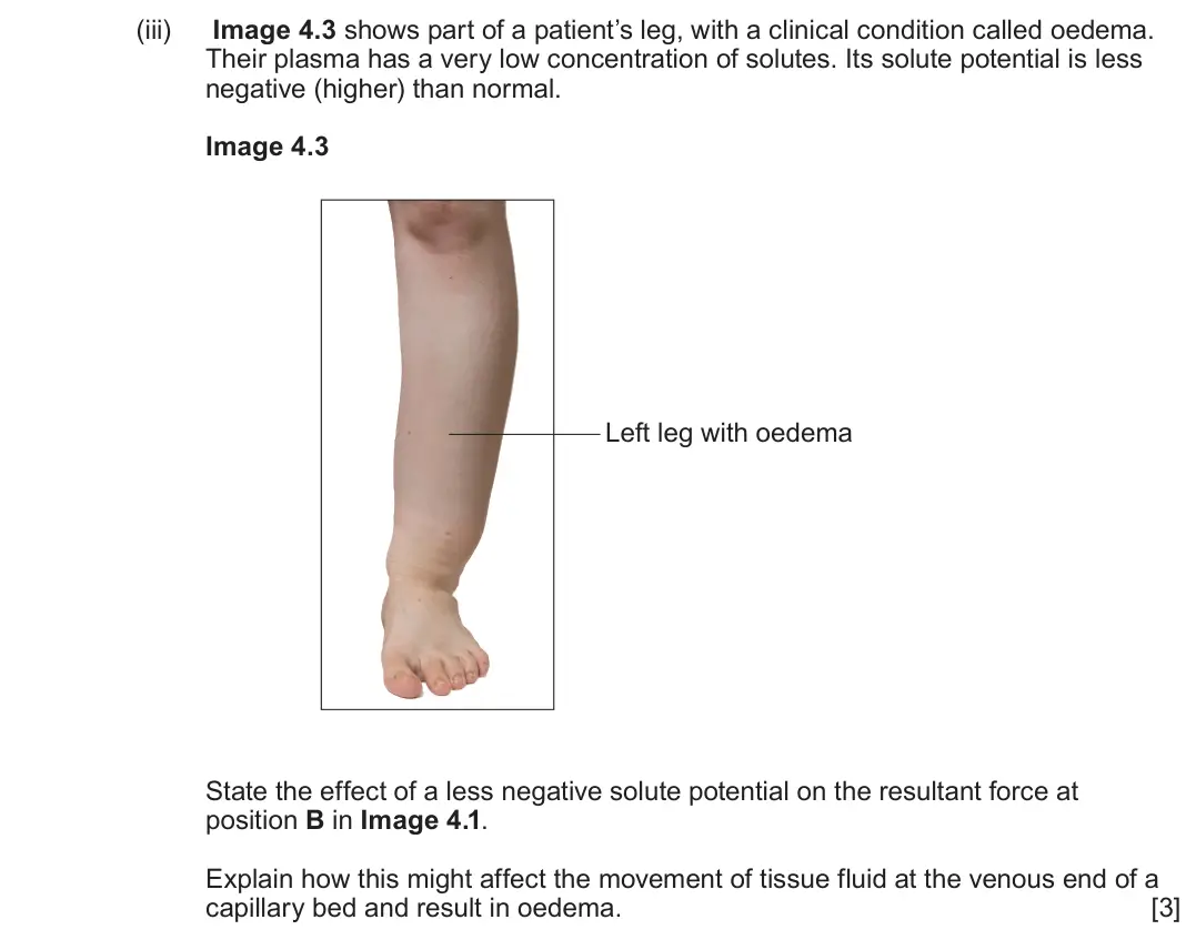 June 2025 AS Component 2, question 4(b)(iii): Image 4.3 shows part of a patient’s leg, with a clinical condition called oedema. Their plasma has a very low concentration of solutes. Its solute potential is 