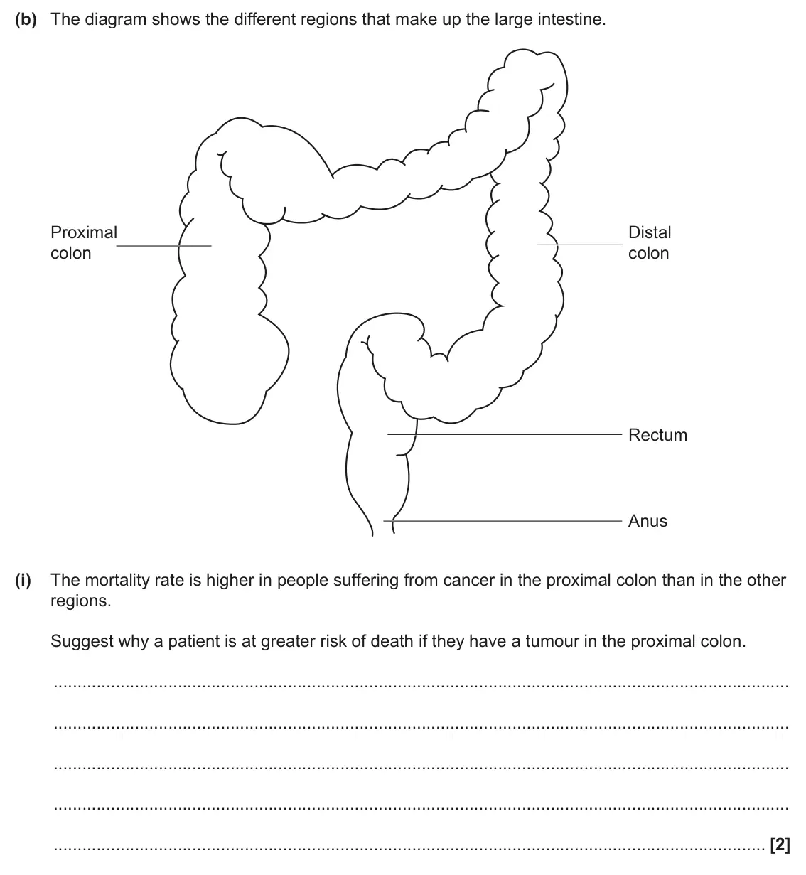 June 2024 AS Paper 2, question 6(b)(i): The mortality rate is higher in people suffering from cancer in the proximal colon than in the other regions. Suggest why a patient is at greater risk of death