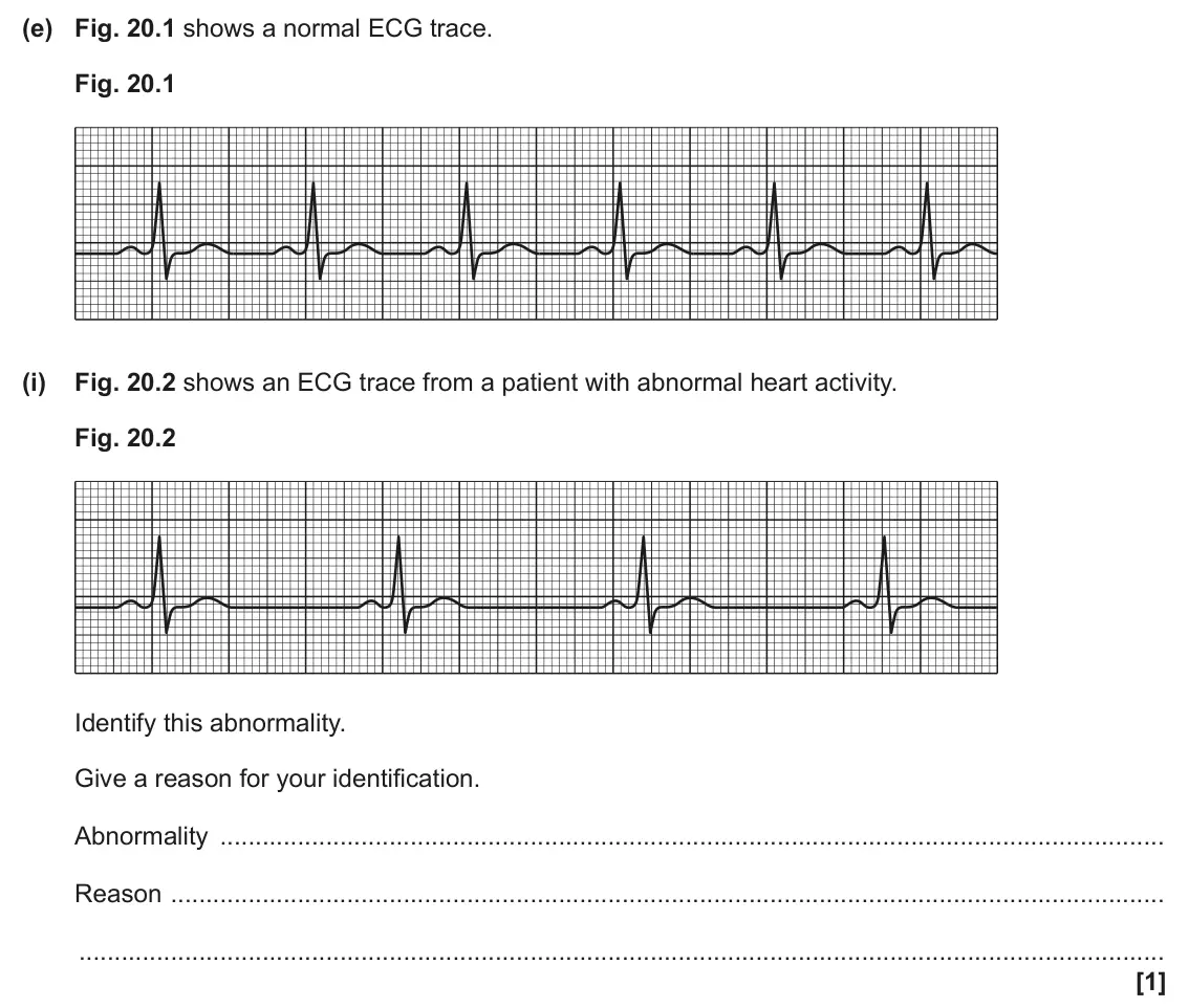 June 2025 Paper 1, question 20(e)(i): Fig. 20.2 shows an ECG trace from a patient with abnormal heart activity. Fig. 20.2 Identify this abnormality. Give a reason for your identification. Abnormalit