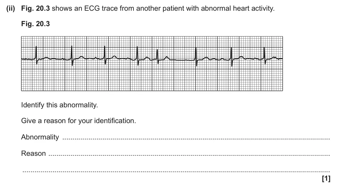 June 2025 Paper 1, question 20(e)(ii): Fig. 20.3 shows an ECG trace from another patient with abnormal heart activity. Fig. 20.3 Identify this abnormality. Give a reason for your identification. Abno