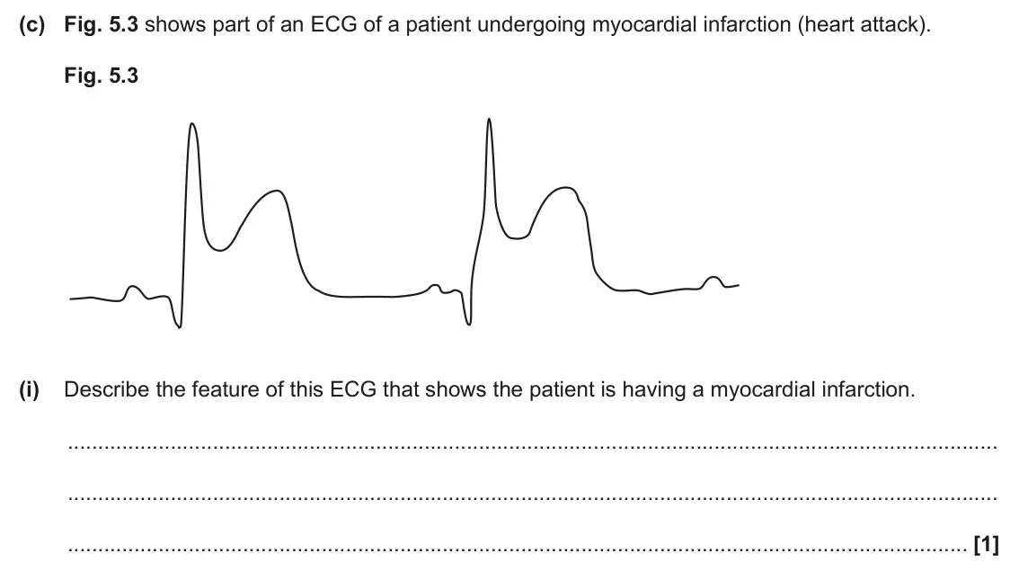 June 2024 Paper 2, question 5(c)(i): Describe the feature of this ECG that shows the patient is having a myocardial infarction. [1]