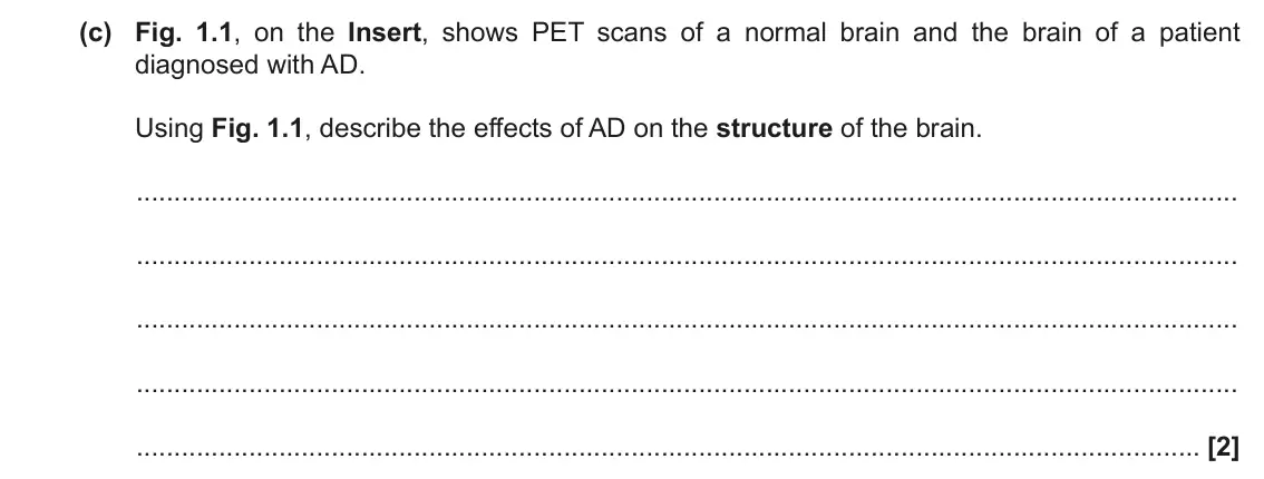 November 2021 Paper 3, question 1(c): Fig. 1.1, on the Insert, shows PET scans of a normal brain and the brain of a patient diagnosed with AD. Using Fig. 1.1, describe the effects of AD on the struc